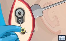 Operate Now: Ear Surgey - Operazione all'orecchio